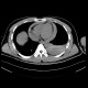 Hemothorax, hemopericardium: CT - Computed tomography